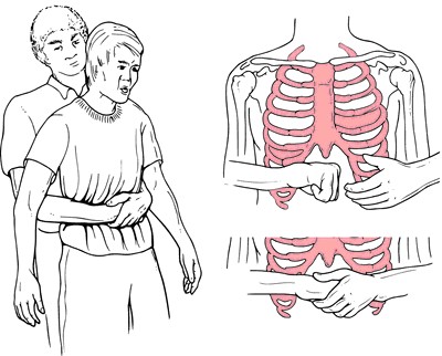 Heimlich-thu-thuat